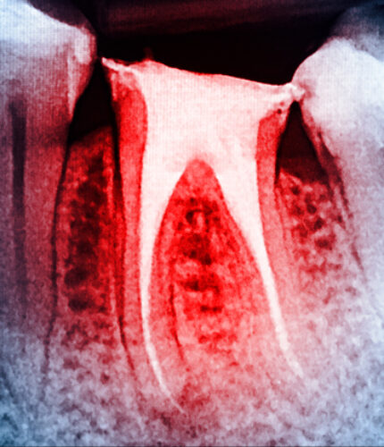 Treatment - 2 Green Dental Boutique