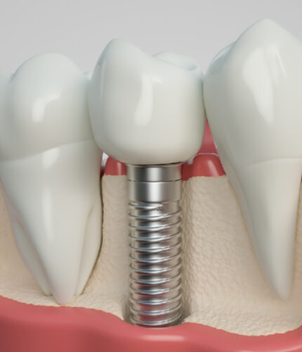 Treatment - 2 Green Dental Boutique