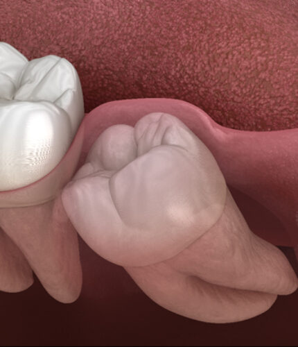 Treatment - 2 Green Dental Boutique